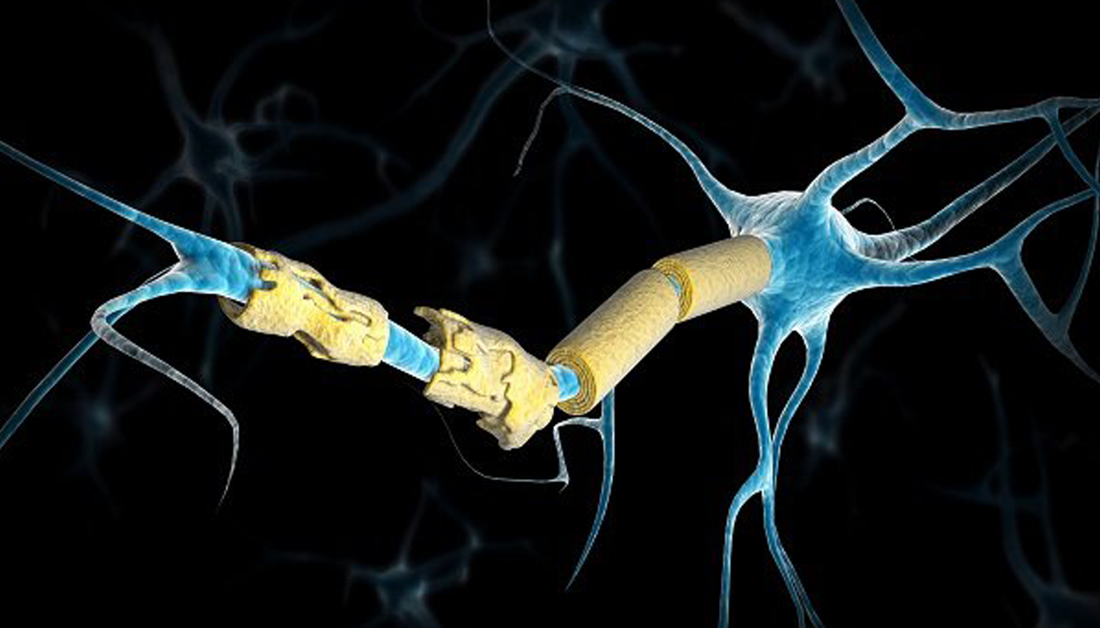 Multiple Sclerosis
