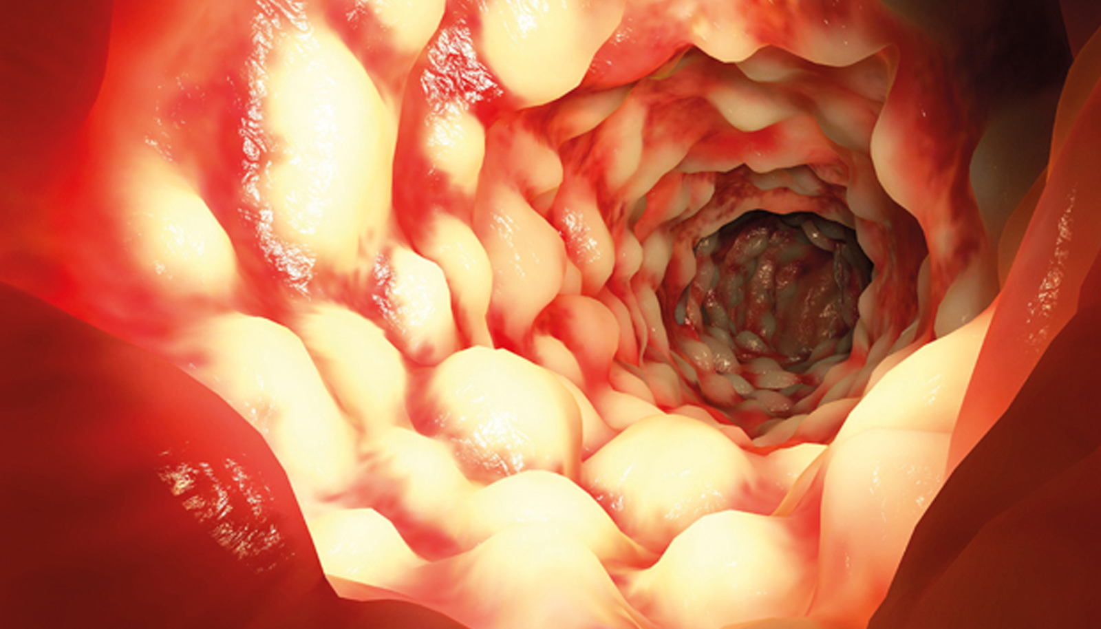 Crohn’s
