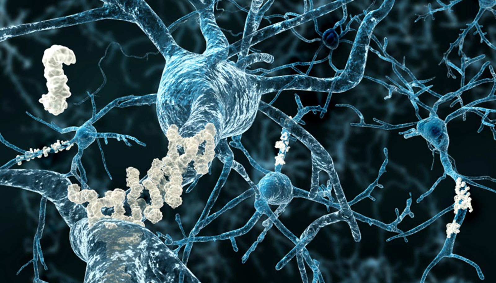 Alzhemir Disease