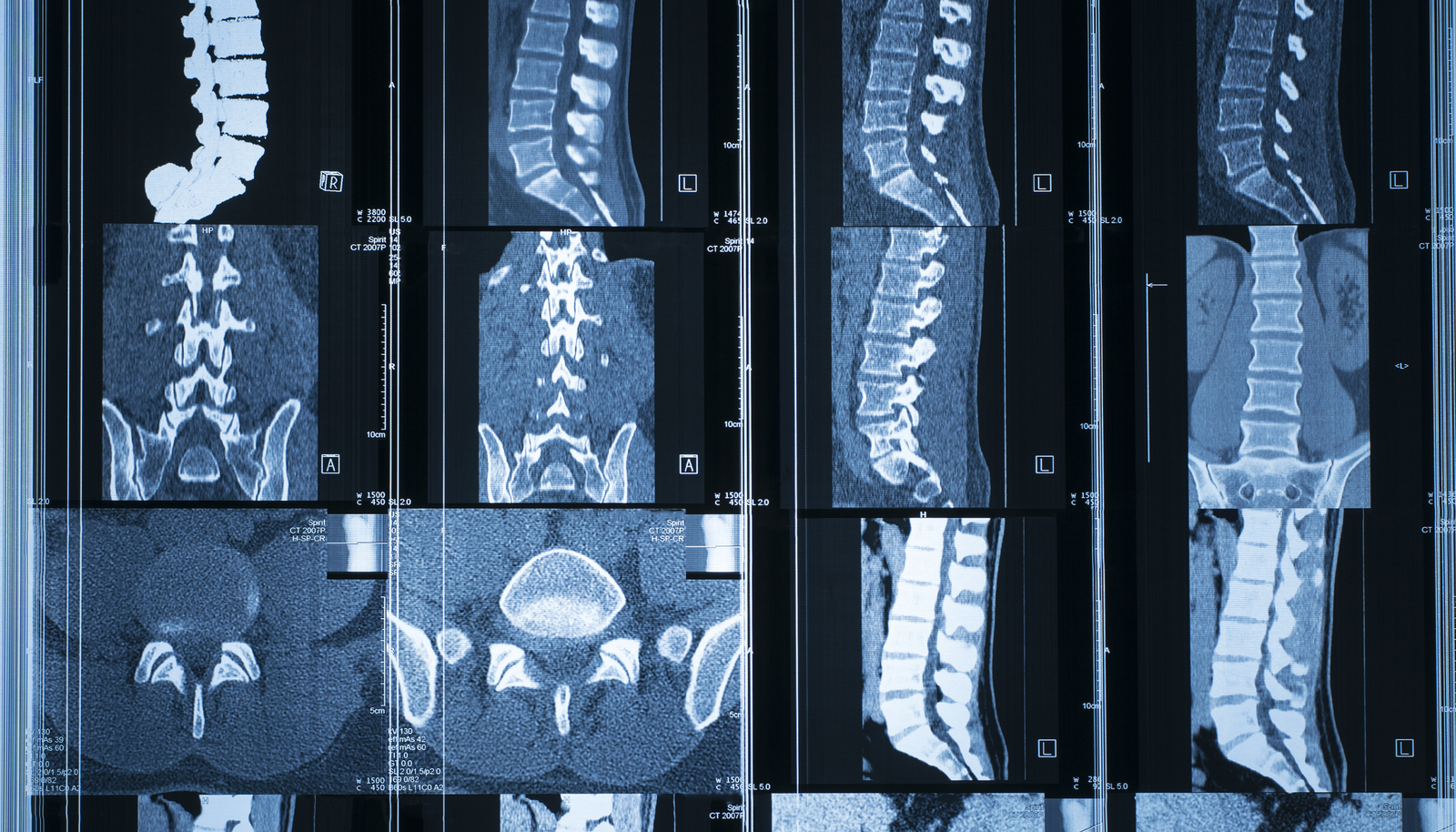 Spinal Cord Injury